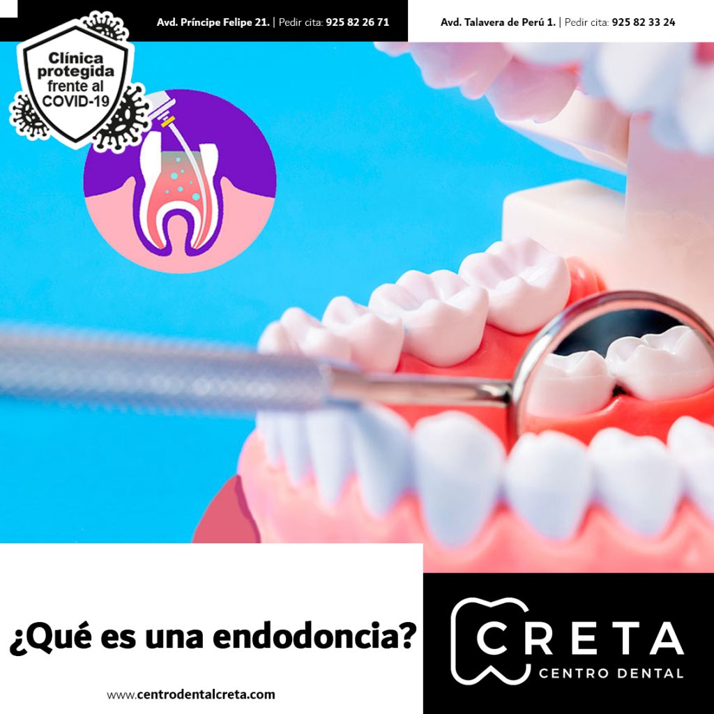 Clinica Dental Creta QuÉ Es Una Endodoncia Y En QuÉ Consiste Zental Clinic Centro Dental De 0713