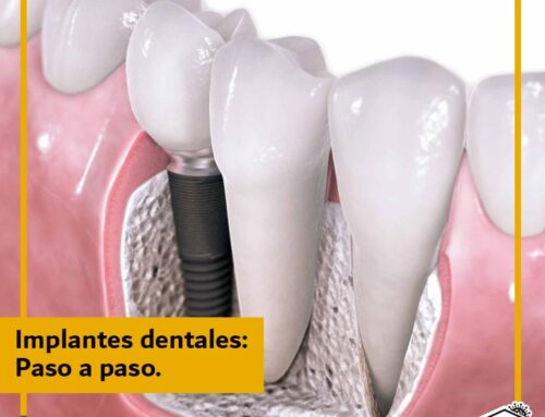 Cómo se hace un implante dental: paso a paso.