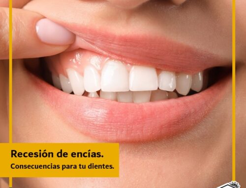 Recesión de encías. Conoce las consecuencias para tus dientes.